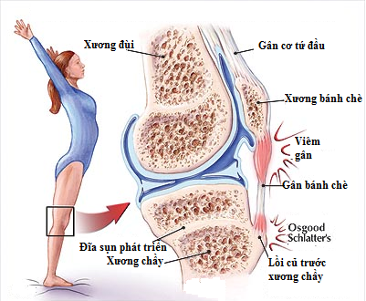 Đứt gân bánh chè - Hình ảnh minh họa
